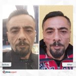 Before and after mini facelift results at CE International Hospital, visible facial rejuvenation