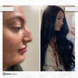 Before and after revision rhinoplasty result at CE International Hospital, improved nose shape
