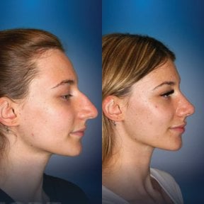 Before and after revision rhinoplasty results at CE International Hospital, improved nose shape