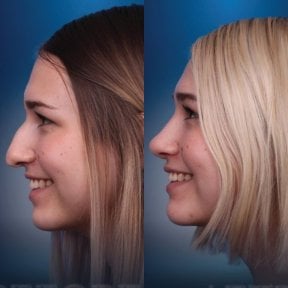 Before and after revision rhinoplasty results at CE International Hospital, improved nose shape