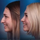 Before and after revision rhinoplasty results at CE International Hospital, improved nose shape