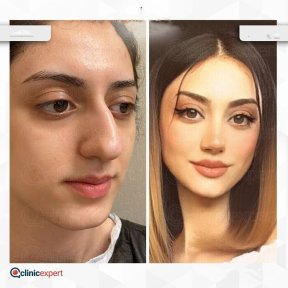 Before and after revision rhinoplasty result at CE International Hospital, refined nose shape
