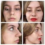 Before and after revision rhinoplasty results at CE International Hospital, improved nose shape