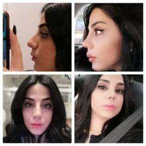 Before and after revision rhinoplasty results at CE International Hospital, improved nose shape