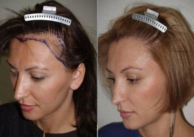 Efekt przed i po przeszczepie włosów DHI w CE International Hospital, poprawiona linia włosów