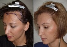 Efekt przed i po przeszczepie włosów DHI w CE International Hospital, poprawiona linia włosów