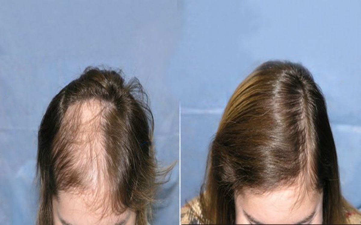 Resultados antes y después de trasplante capilar DHI en CE International Hospital para alopecia femenina