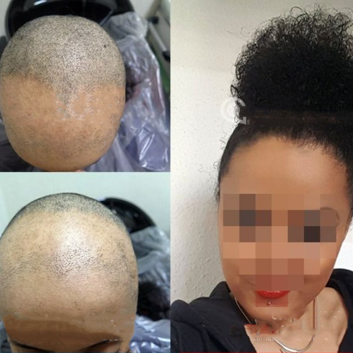 Resultados de trasplante capilar DHI antes y después en CE International Hospital, línea restaurada