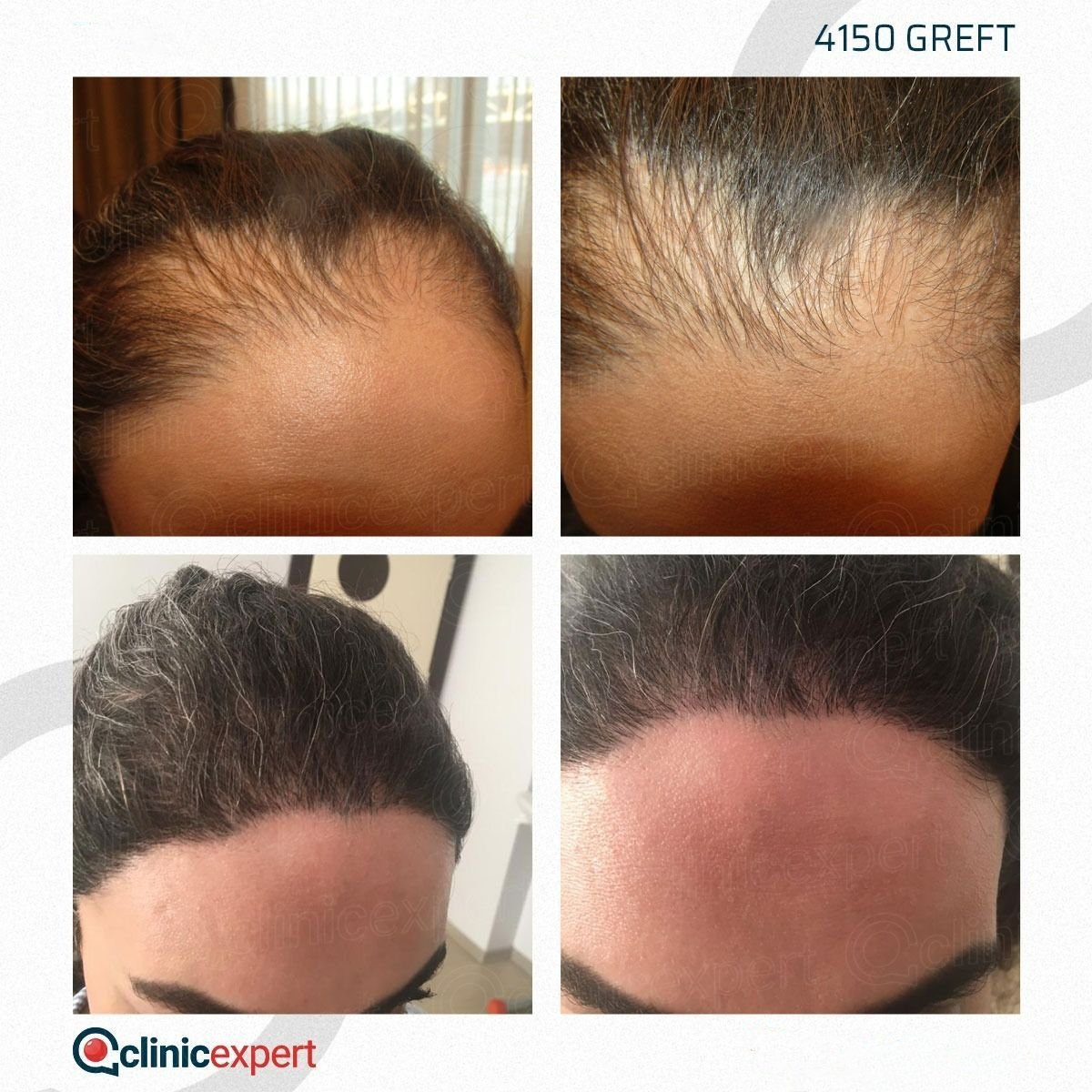 Resultados antes y después de trasplante capilar DHI en CE International Hospital, 4150 injertos