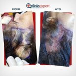 Результати до та після DHI пересадки волосся в CE International Hospital, покращена густота