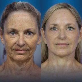 Facelift before and after results at CE International Hospital – visible facial rejuvenation
