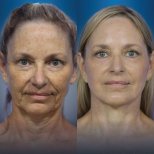 Facelift before and after results at CE International Hospital – visible facial rejuvenation