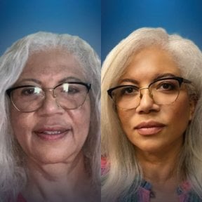 Facelift before and after results at CE International Hospital – visible facial rejuvenation