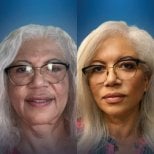 Facelift before and after results at CE International Hospital – visible facial rejuvenation