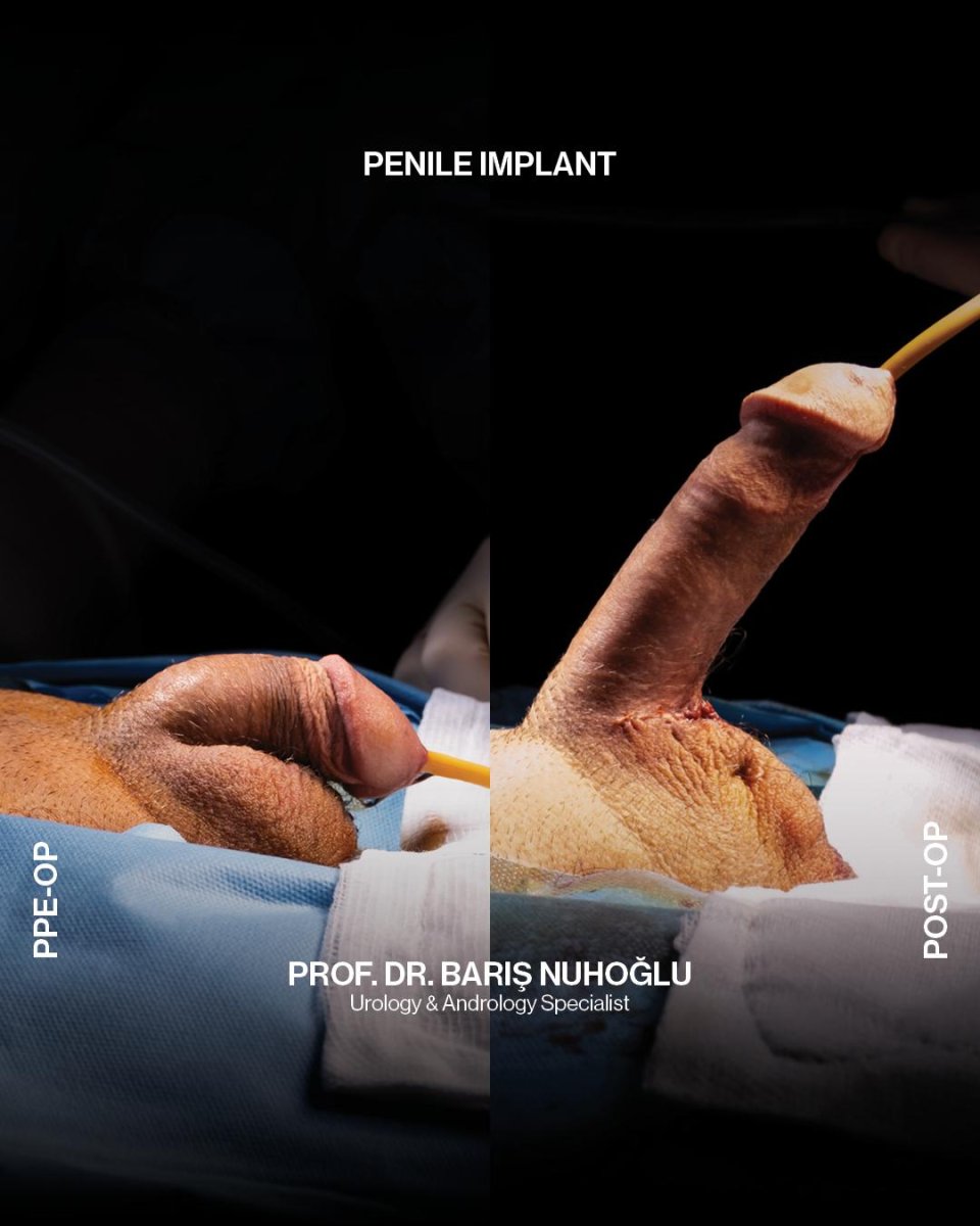 نتائج قبل وبعد زراعة دعامة القضيب في Men's Health Clinics مع تحسين الوظيفة