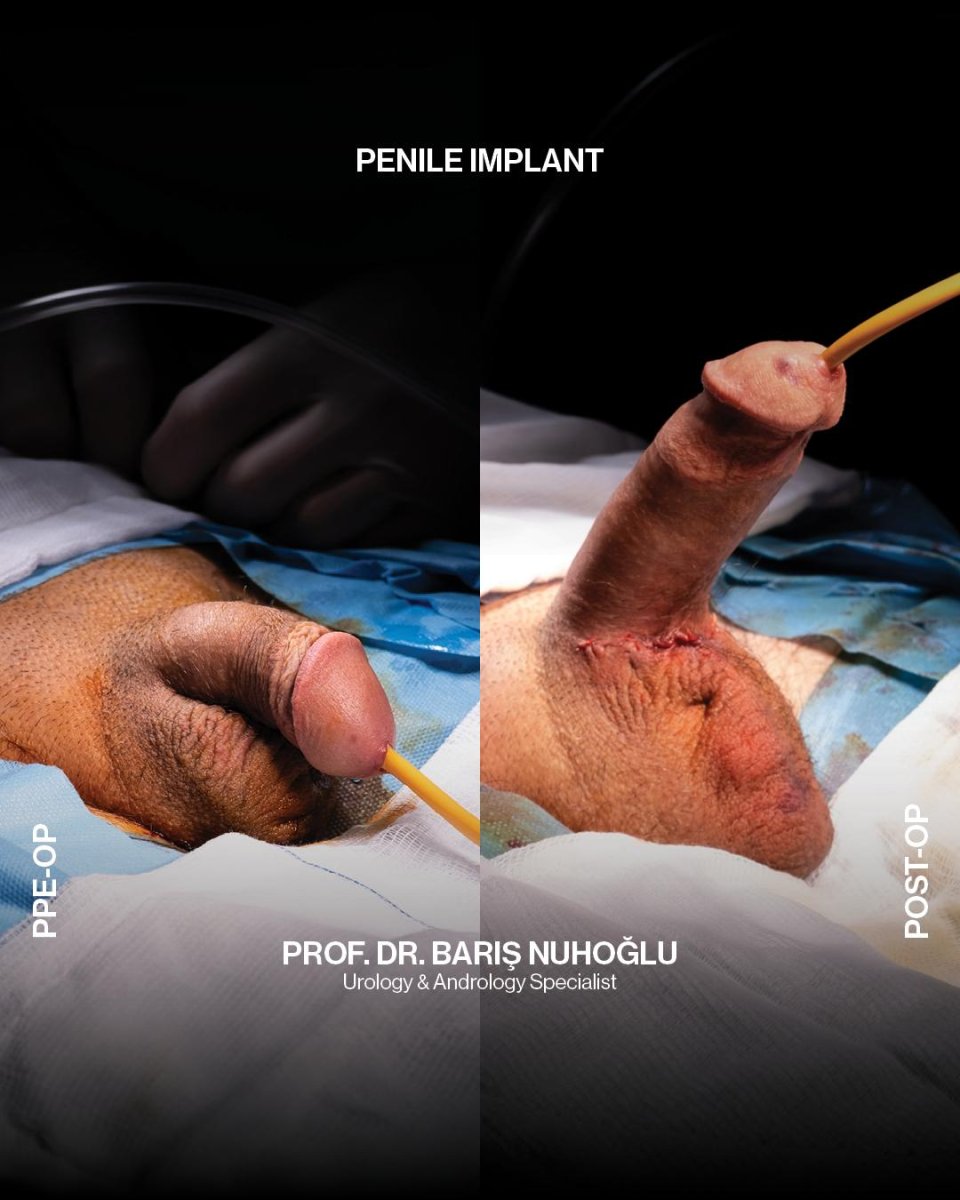 نتائج قبل وبعد جراحة زرع القضيب في Men's Health Clinics، تحسن ملحوظ