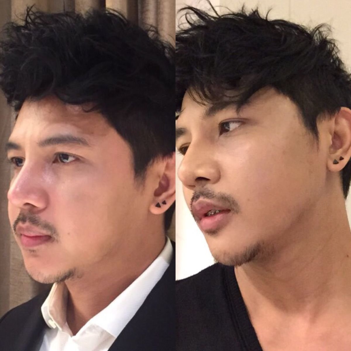 Результати до і після безопераційної підтяжки обличчя в Asia Cosmetic Hospital, покращений контур