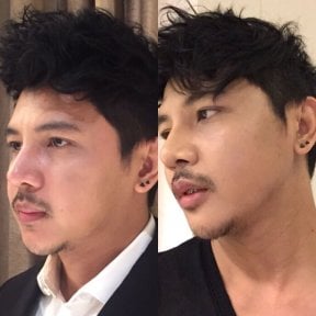 نتائج شد الوجه غير الجراحي قبل وبعد في Asia Cosmetic Hospital، تحديد الفك المحسن