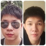 نتائج شد الوجه غير الجراحي قبل وبعد في Asia Cosmetic Hospital، تجديد شباب الوجه