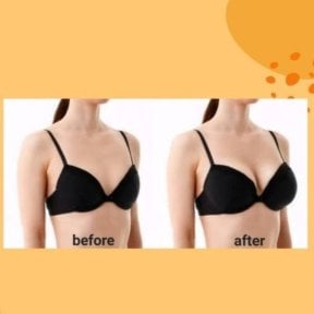 Before and after breast augmentation results at ID Clinic Bangkok, enhanced breast volume