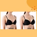 Before and after breast augmentation results at ID Clinic Bangkok, enhanced breast volume