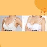 Résultats avant et après augmentation mammaire à ID Clinic Bangkok, volume des seins accru