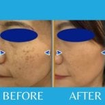 Before and after laser skin resurfacing at ID Clinic Bangkok, improved facial pigmentation result
