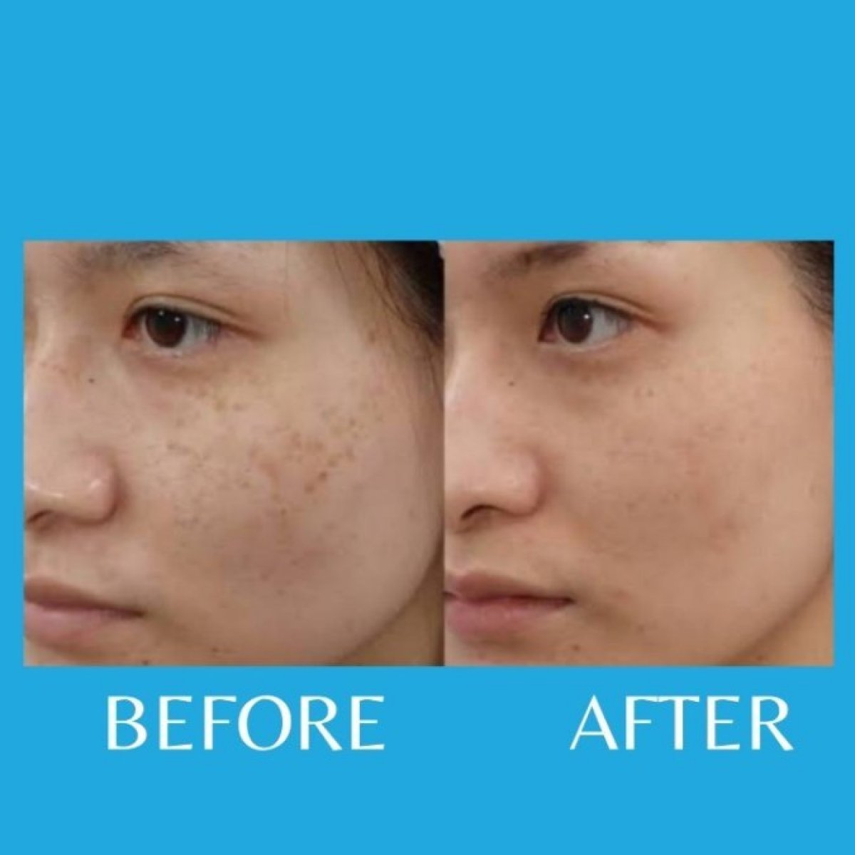 Antes y después de resurfacing láser en ID Clinic Bangkok, mejora de la textura facial
