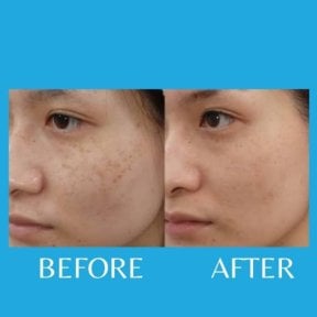 Before and after laser skin resurfacing at ID Clinic Bangkok, improved facial skin texture result