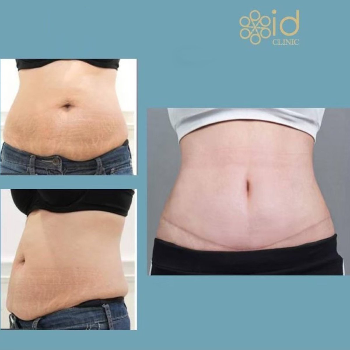 Resultados antes y después de Vaser 3 áreas más abdominoplastia en ID Clinic Bangkok