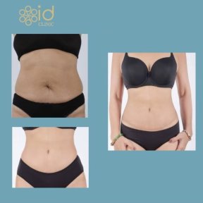 Before and after Vaser 3 areas plus tummy tuck results at ID Clinic Bangkok, slimmer waistline