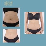 Before and after Vaser 3 areas plus tummy tuck results at ID Clinic Bangkok, slimmer waistline