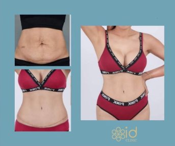 Before and after Vaser 3 areas plus tummy tuck results at ID Clinic Bangkok, body contouring