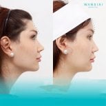 Before and after facelift results at Wansiri Hospital, visible facial contour improvement