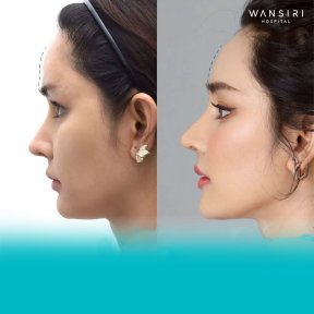 Before and after facelift results at Wansiri Hospital, visible facial contour enhancement