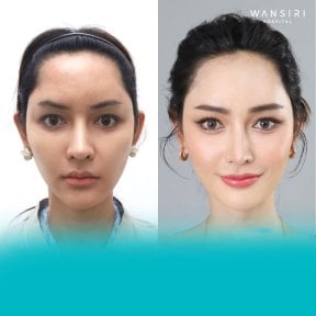 Before and after facelift results at Wansiri Hospital, facial rejuvenation and contouring