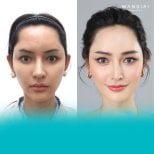 Before and after facelift results at Wansiri Hospital, facial rejuvenation and contouring