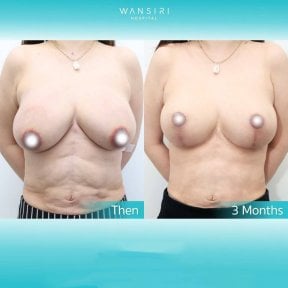 Mommy makeover before and after results at Wansiri Hospital – breast and abdomen contouring