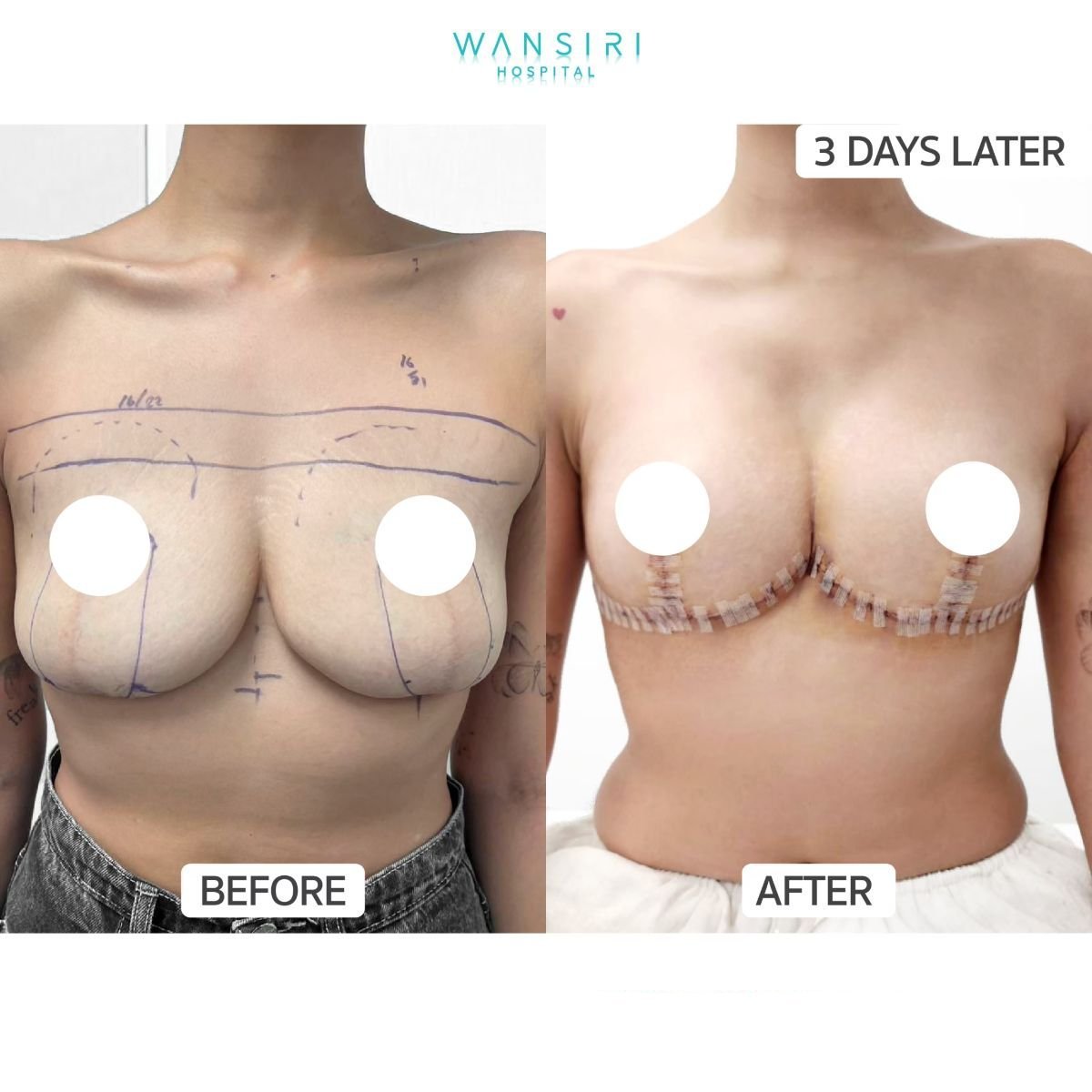 Antes y después de mommy makeover en Wansiri Hospital, resultados de levantamiento de senos