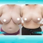 Before and after mommy makeover at Wansiri Hospital, visible breast lift and body contour result