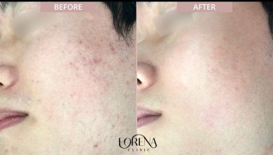 Результаты до и после лечения рубцов от акне в Forena Clinic, улучшение текстуры кожи