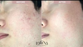 Результаты до и после лечения рубцов от акне в Forena Clinic, улучшение текстуры кожи