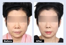 Результаты до и после deep plane SMAS-лифтинга в URBAN Plastic Surgery, омоложение лица