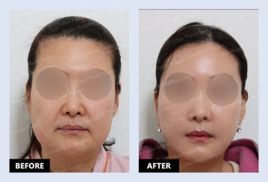 Результаты до и после Deep Plane Facelift в URBAN Plastic Surgery – омоложение лица