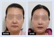 Результаты до и после Deep Plane Facelift в URBAN Plastic Surgery – омоложение лица
