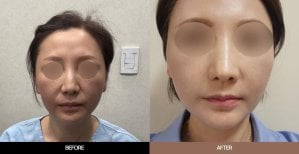 Результаты до и после Deep Plane Facelift в URBAN Plastic Surgery, омоложение лица