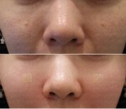 Результаты до и после лечения рубцов от акне в Forena Clinic, более гладкая кожа лица