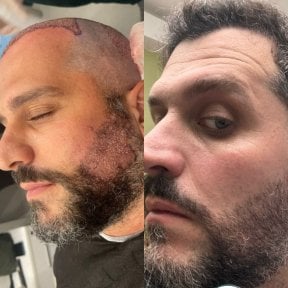 Before and after beard transplant results at Estemarley – fuller, natural beard appearance