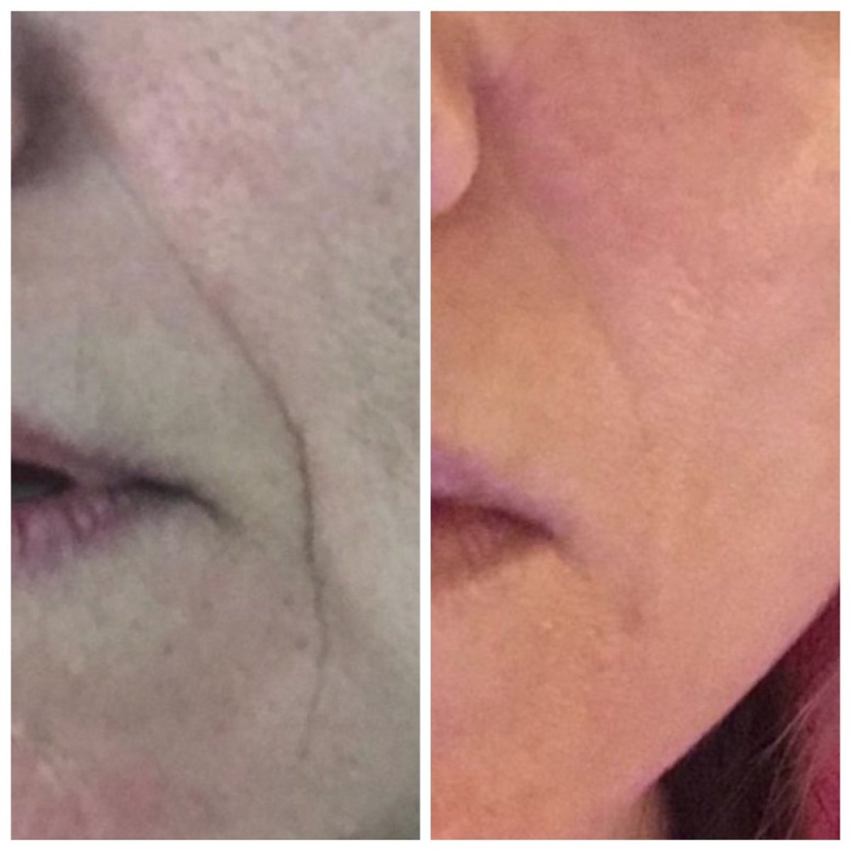 Antes y después de rellenos en Clinica Granado Tiagonce, reducción de arrugas faciales