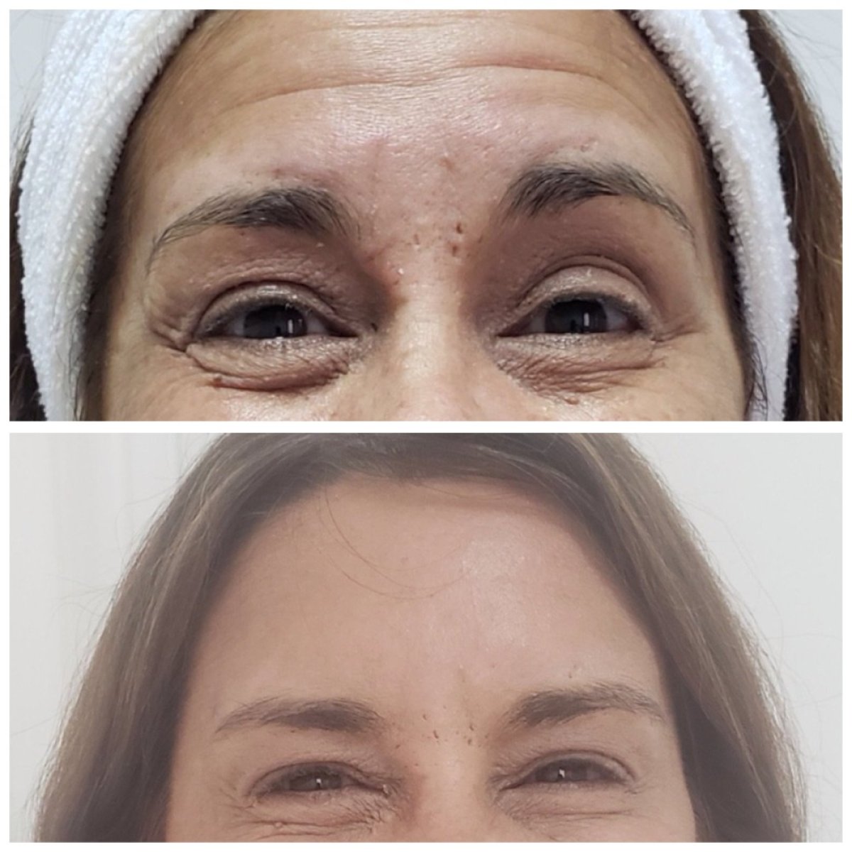 Antes y después de inyecciones de relleno en Clinica Granado Tiagonce, menos arrugas oculares